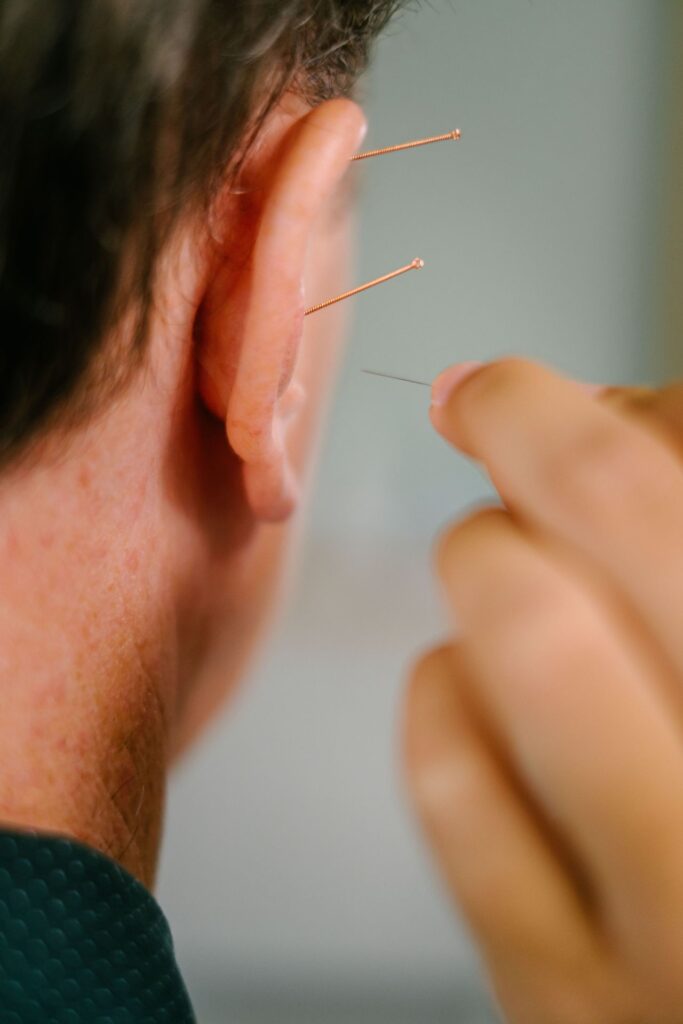 Close up picture of ear with acupuncture needles inserted